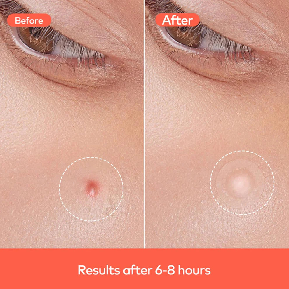 Pimple Patches – Hydrocolloid & Tea Tree Oil for Acne