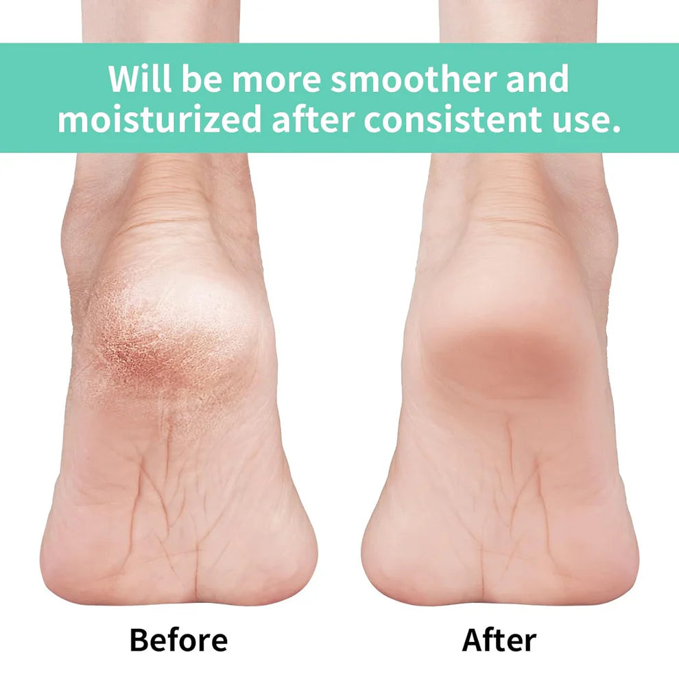 Silicone Gel Heel Socks – Cracked Heels Remedy